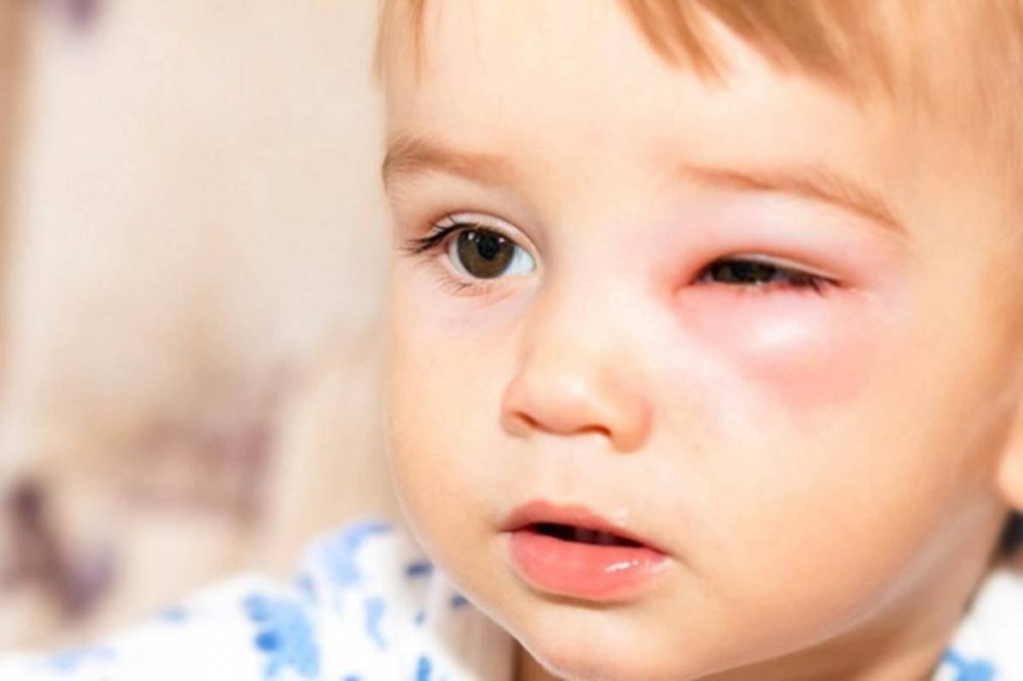 [Gợi ý]: 10+ mẹo chữa lẹo mắt ở trẻ em nhanh nhất