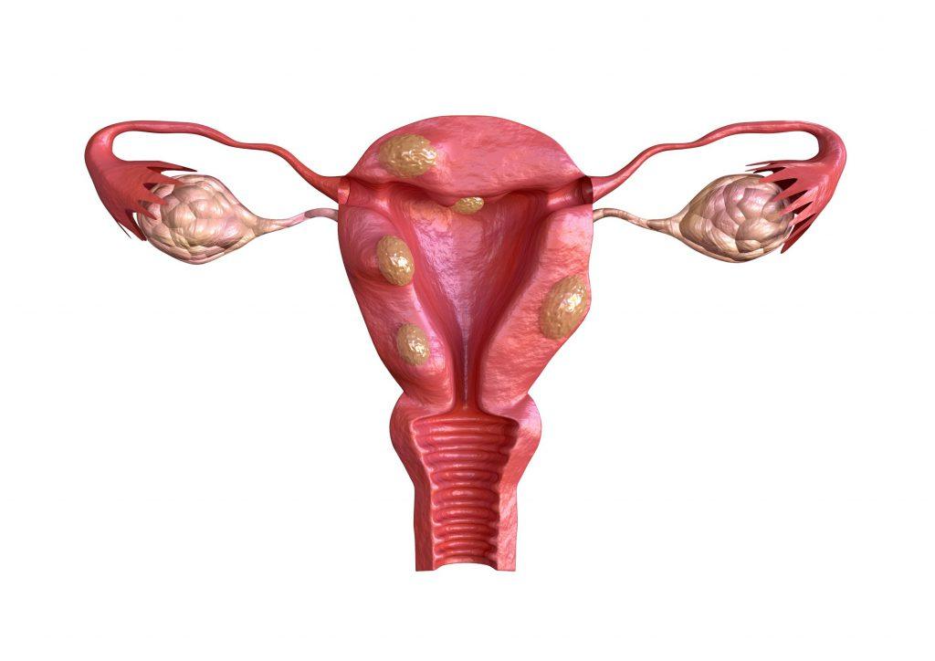 Đau bụng dưới bên phải gần háng ở nữ nguy cơ u xơ tử cung