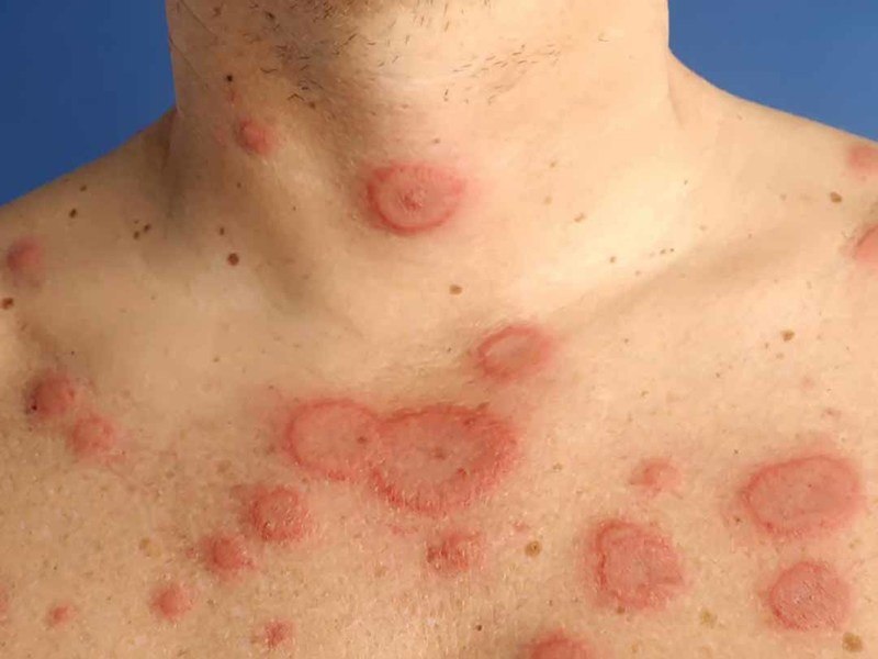 Vết tròn đỏ trên da không ngứa: Lupus ban đỏ dạng đĩa
