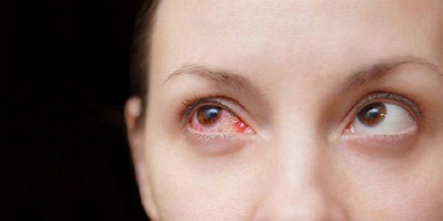 Các mẹo chữa đau mắt đỏ nhanh nhất, mẹo cuối cực đơn giản